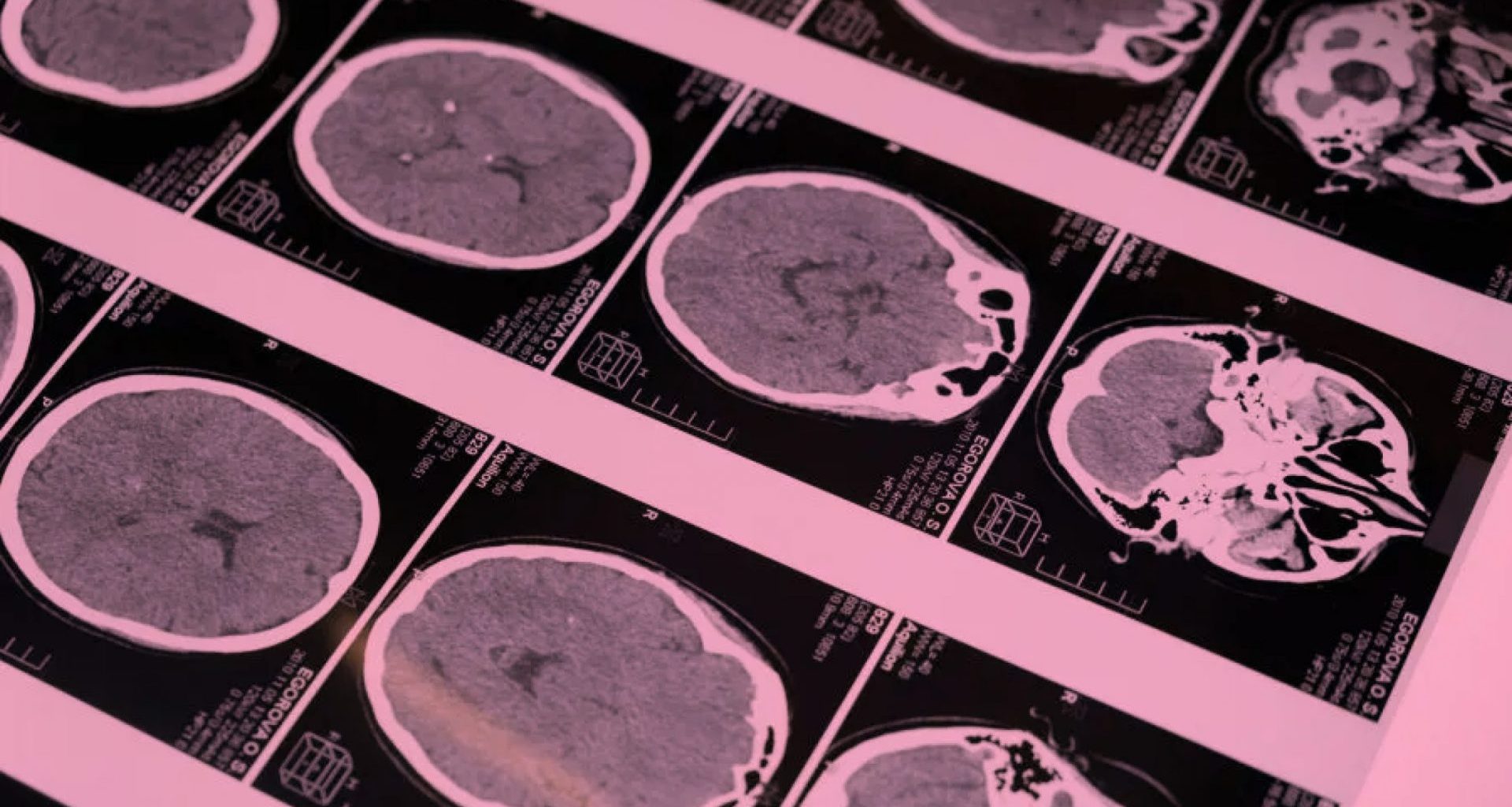 raio-x de cranio para ilustrar mutação somática e doenças neuropsiquiátricas