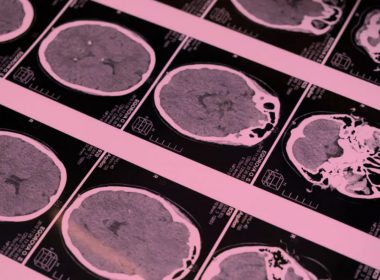 raio-x de cranio para ilustrar mutação somática e doenças neuropsiquiátricas