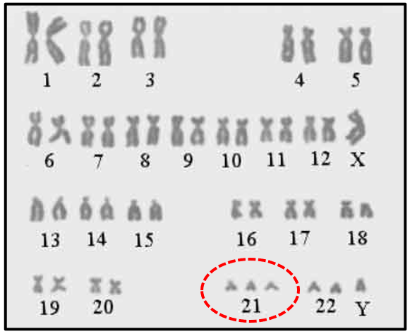 trissomia no cromossomo 21 visualizada em cromossomos