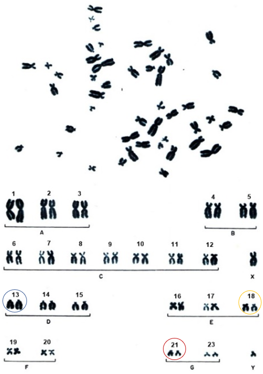 Alterações cromossômicas causadora de condições atípicas.