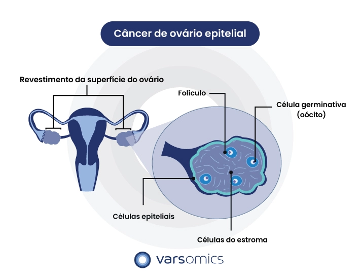 Câncer de ovário epitelial