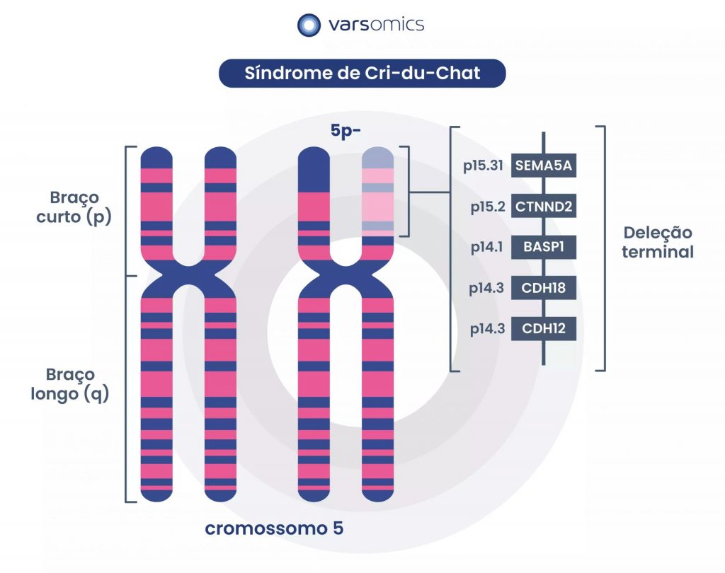 Cri-du-Chat: Cromossomo 5 com deleção no braço curto. Na imagem, evidencia-se a presença de alguns genes deletados.