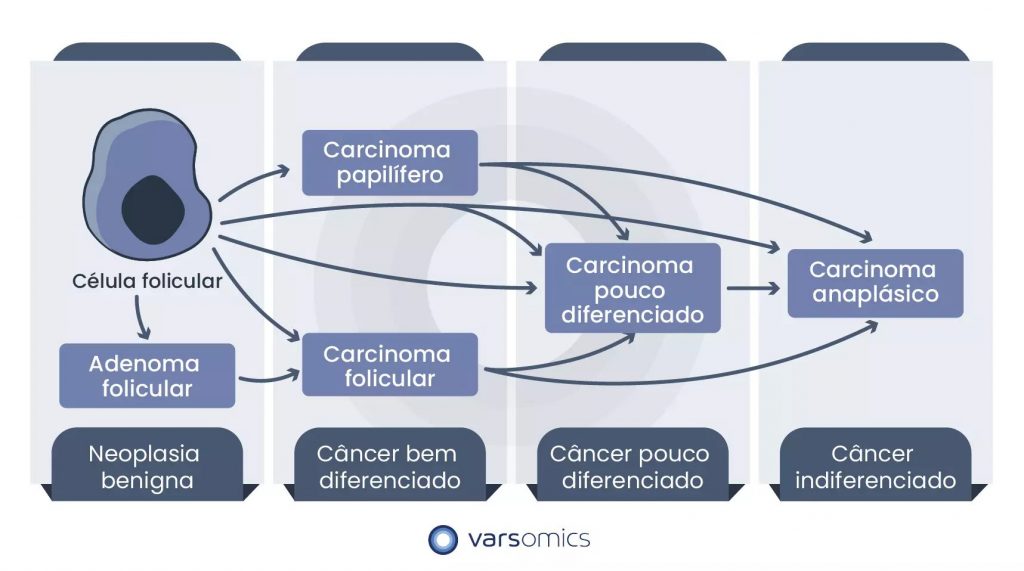 Representação esquemática da classificação dos carcinomas da tireoide. Adenocarcinomas foliculares e papilares podem dar origem a um carcinoma anaplásico